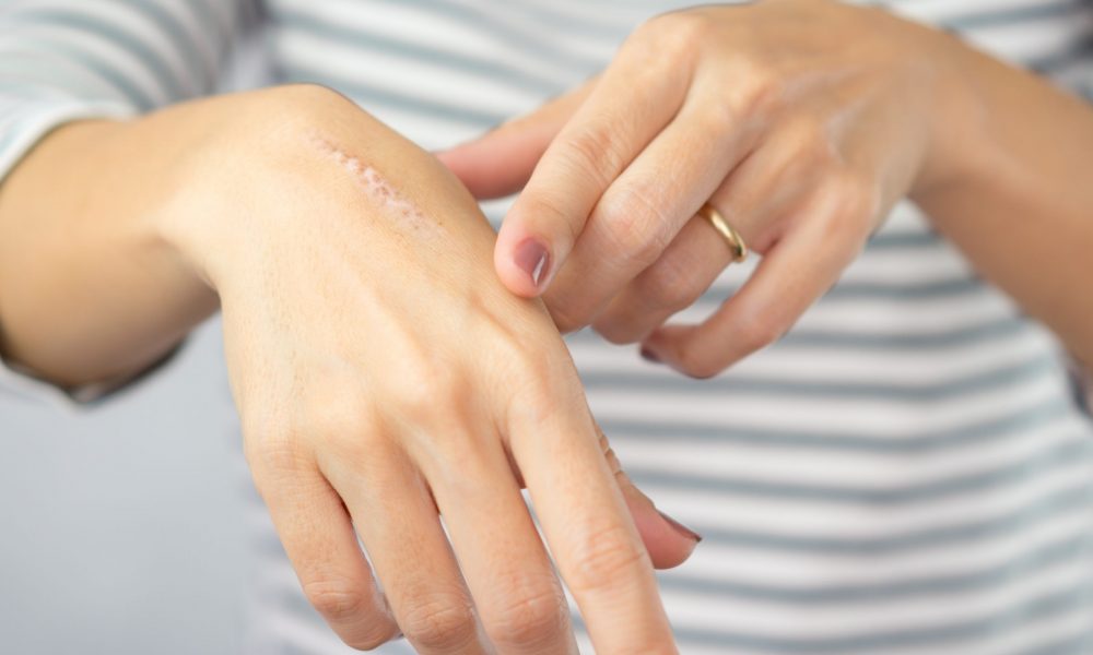 Woman puts oil on scar on hand