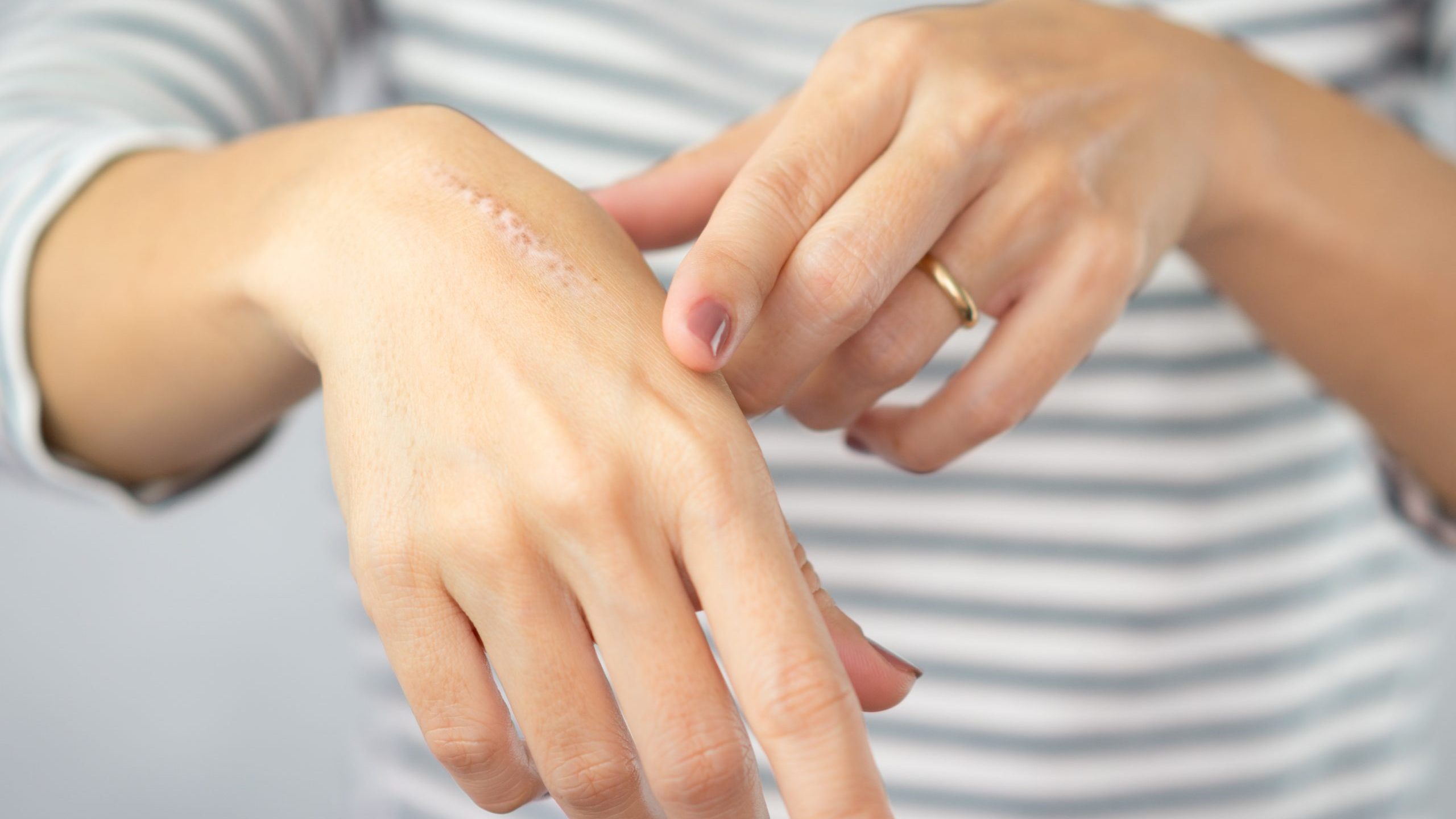 Woman puts oil on scar on hand