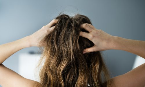 Itching Dry Head Scalp And Long Hair With Dandruff